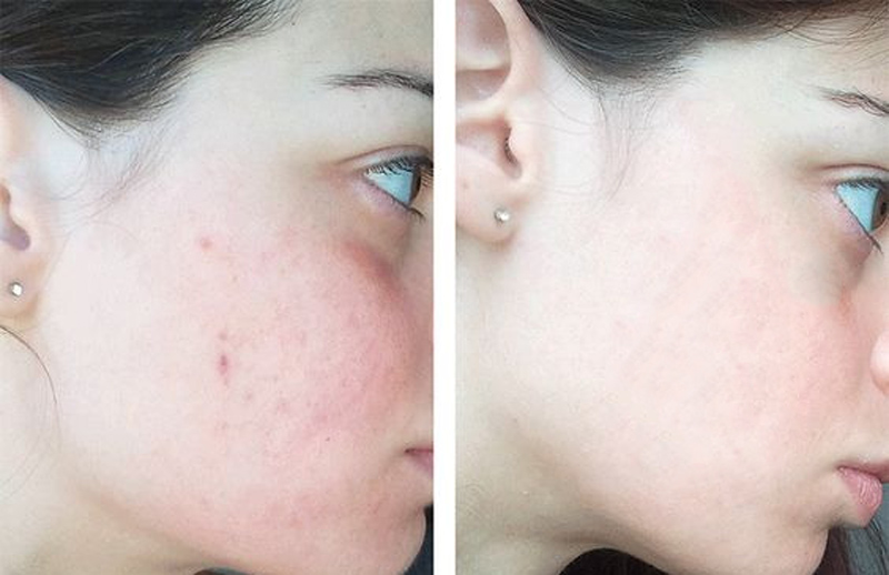 Sữa Rửa Mặt Meishoku Acne Bigansui Facial Wash giúp rửa sạch vượt trội với tác dụng kháng khuẩn, ngừa mụn 